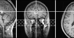 ADHD drugs increase brain glutamate predict positive emotion in healthy people