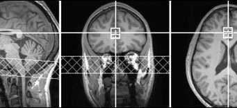 ADHD drugs increase brain glutamate, predict positive emotion in healthy people ADHD drugs increase brain glutamate predict positive emotion in healthy people