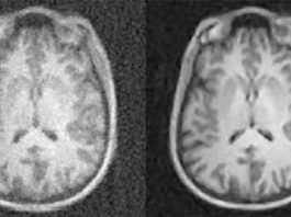 New artificial intelligence technique dramatically improves the quality of medical imaging