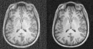 New artificial intelligence technique dramatically improves the quality of medical imaging