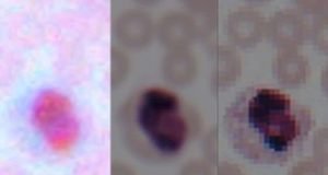 Deep learning transforms smartphone microscopes into laboratory grade devices