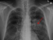 Nanoparticles for lung cancer pass next test