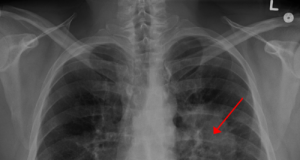 Nanoparticles for lung cancer pass next test