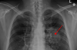 Nanoparticles for lung cancer pass next test Nanoparticles for lung cancer pass next test