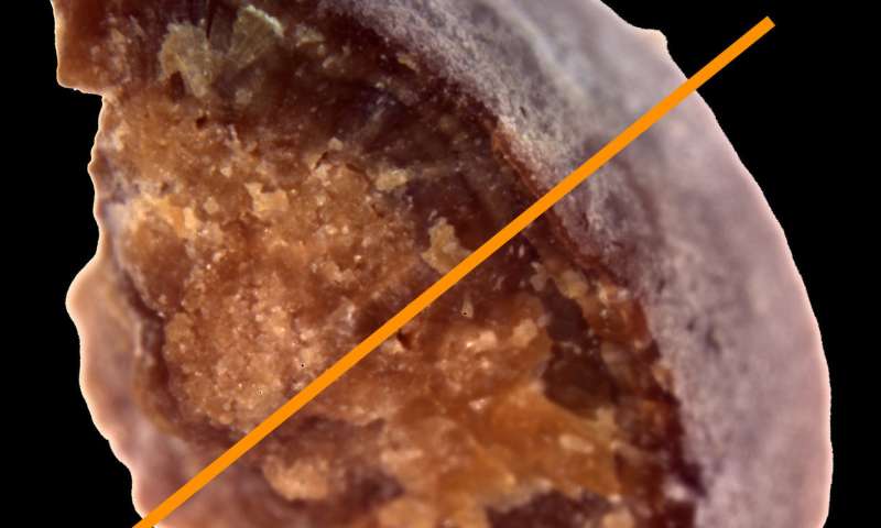 Kidney stones have distinct geological histories study finds