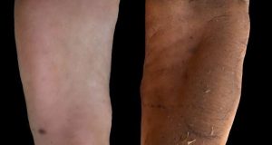 cropped Why your foot calluses might be good for you