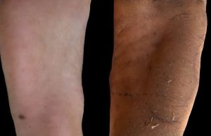 Why your foot calluses might be good for you cropped Why your foot calluses might be good for you