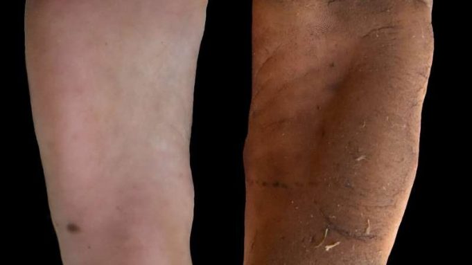 Why your foot calluses might be good for you cropped Why your foot calluses might be good for you