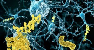cropped An alternate theory for what causes Alzheimers disease