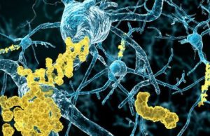 An alternate theory for what causes Alzheimer’s disease cropped An alternate theory for what causes Alzheimers disease