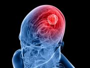 cropped Delivering immunotherapy directly to brain tumor