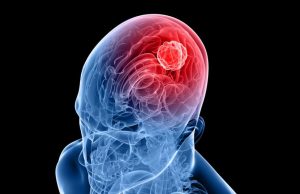 Delivering immunotherapy directly to brain tumors cropped Delivering immunotherapy directly to brain tumor