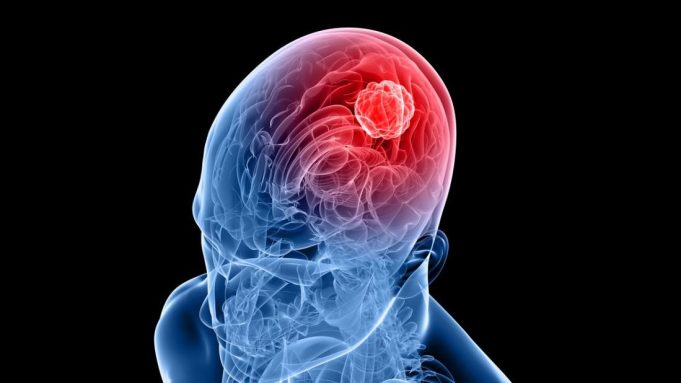 cropped Delivering immunotherapy directly to brain tumor
