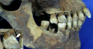 cropped Teeth offer vital clues about diet during the Great Irish Famine