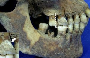 cropped Teeth offer vital clues about diet during the Great Irish Famine