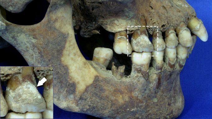 Teeth offer vital clues about diet during the Great Irish Famine cropped Teeth offer vital clues about diet during the Great Irish Famine