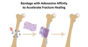Bone bandage soaks up pro healing biochemical to accelerate repair