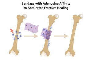 Bone bandage soaks up pro-healing biochemical to accelerate repair Bone bandage soaks up pro healing biochemical to accelerate repair