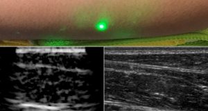 Researchers produce first laser ultrasound images of humans