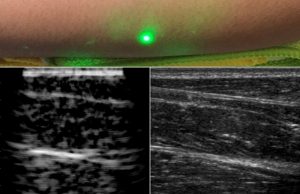 Researchers produce first laser ultrasound images of humans Researchers produce first laser ultrasound images of humans