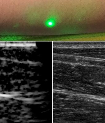 Researchers produce first laser ultrasound images of humans