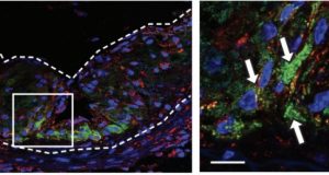 Nanoparticle chomps away plaques that cause heart attacks