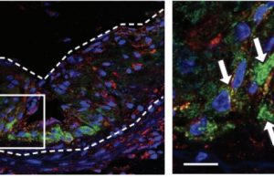 Nanoparticle chomps away plaques that cause heart attacks Nanoparticle chomps away plaques that cause heart attacks