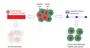 Ultrasound selectively damages cancer cells when tuned to correct frequencies