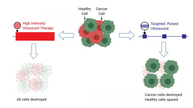 Ultrasound selectively damages cancer cells when tuned to correct frequencies Ultrasound selectively damages cancer cells when tuned to correct frequencies