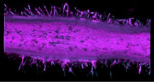 Pancreatic cancer time machine exposes plot twist in cell growth and invasion
