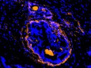 Cancerous tumors surrounding cells illuminated by new imaging agent
