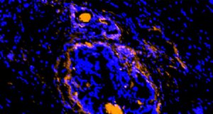 Cancerous tumors surrounding cells illuminated by new imaging agent