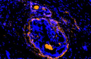 Cancerous tumors, surrounding cells illuminated by new imaging agent Cancerous tumors surrounding cells illuminated by new imaging agent