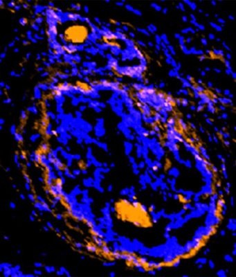 Cancerous tumors surrounding cells illuminated by new imaging agent