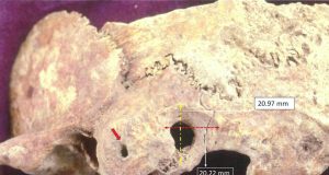 Researcher discovers early complex brain surgery in ancient Greece