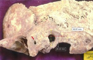 Researcher discovers early, complex brain surgery in ancient Greece Researcher discovers early complex brain surgery in ancient Greece