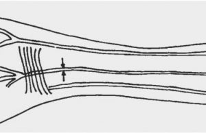 Forearm artery reveals humans evolving from changes in natural selection