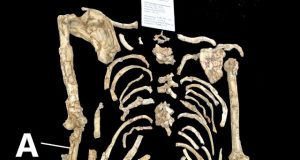 Is forearm curvature in the Little Foot Australopithecus natural or pathological