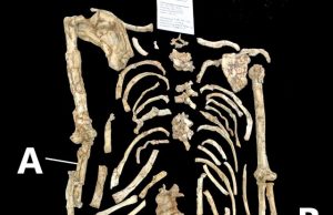 Is forearm curvature in the Little Foot Australopithecus natural or pathological