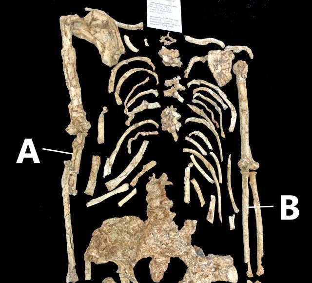 Is forearm curvature in the Little Foot Australopithecus natural or pathological