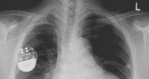 Nano thin piezoelectrics advance self powered electronics